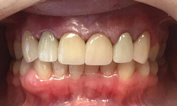 Image Text: Teeth Straightening