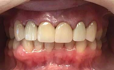 Image Text: Teeth Straightening