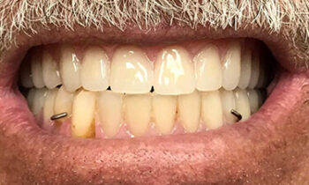 Image Text: Invisalign