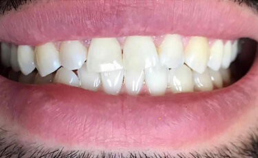 Invisalign Without Insurance